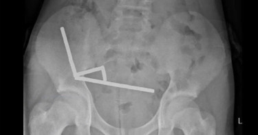 কিশোরের পেটে মিললো অন্তত ১০০ চুম্বক