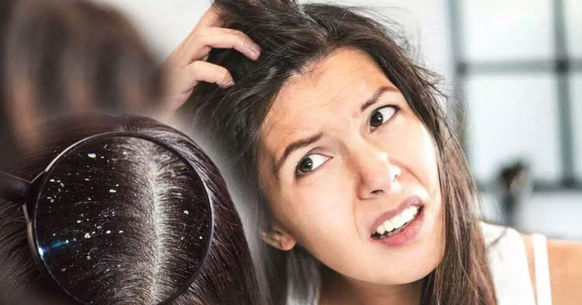 যে ভিটামিনের অভাবে খুশকি হয়