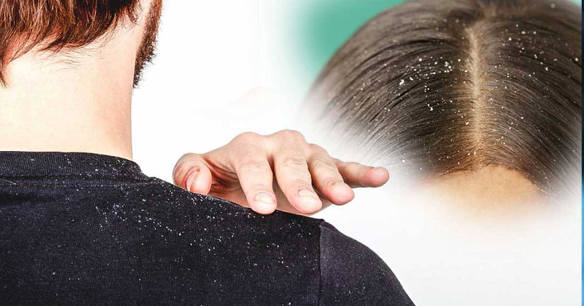 শীতে খুশকি দূর করার ঘরোয়া ৯ উপায়