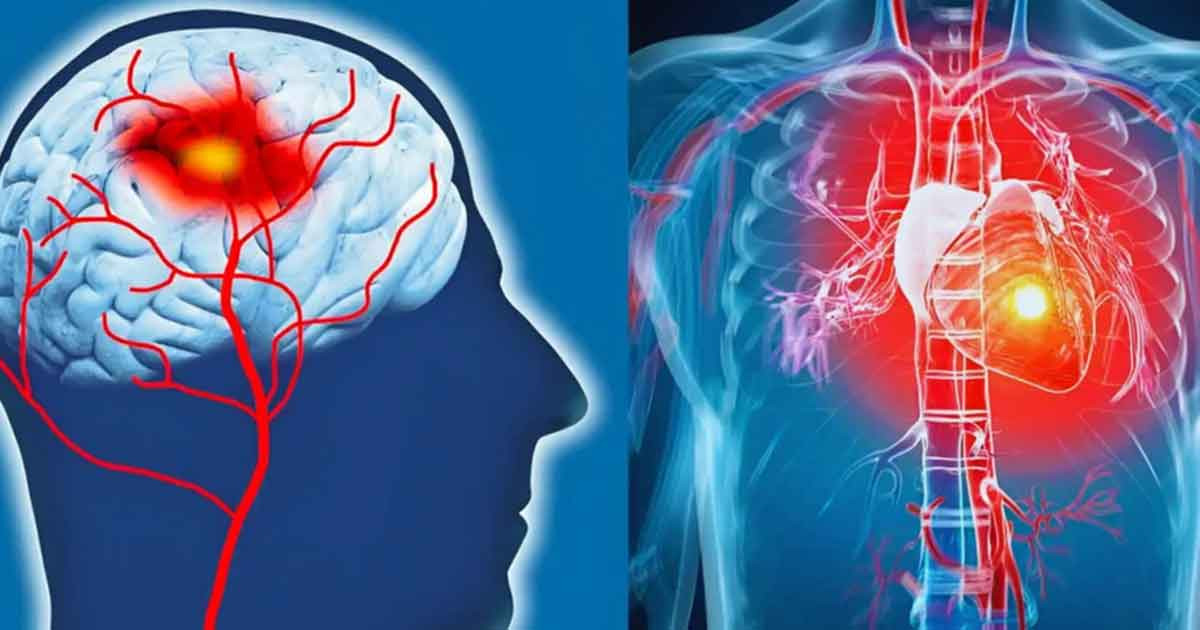 স্ট্রোক ও হার্ট অ্যাটাক কোনটি বেশি মারাত্মক