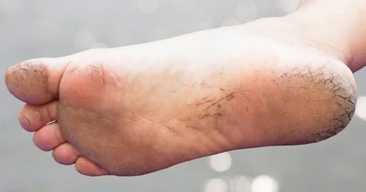 পা ফাটার কারণ যে ৪ রোগ