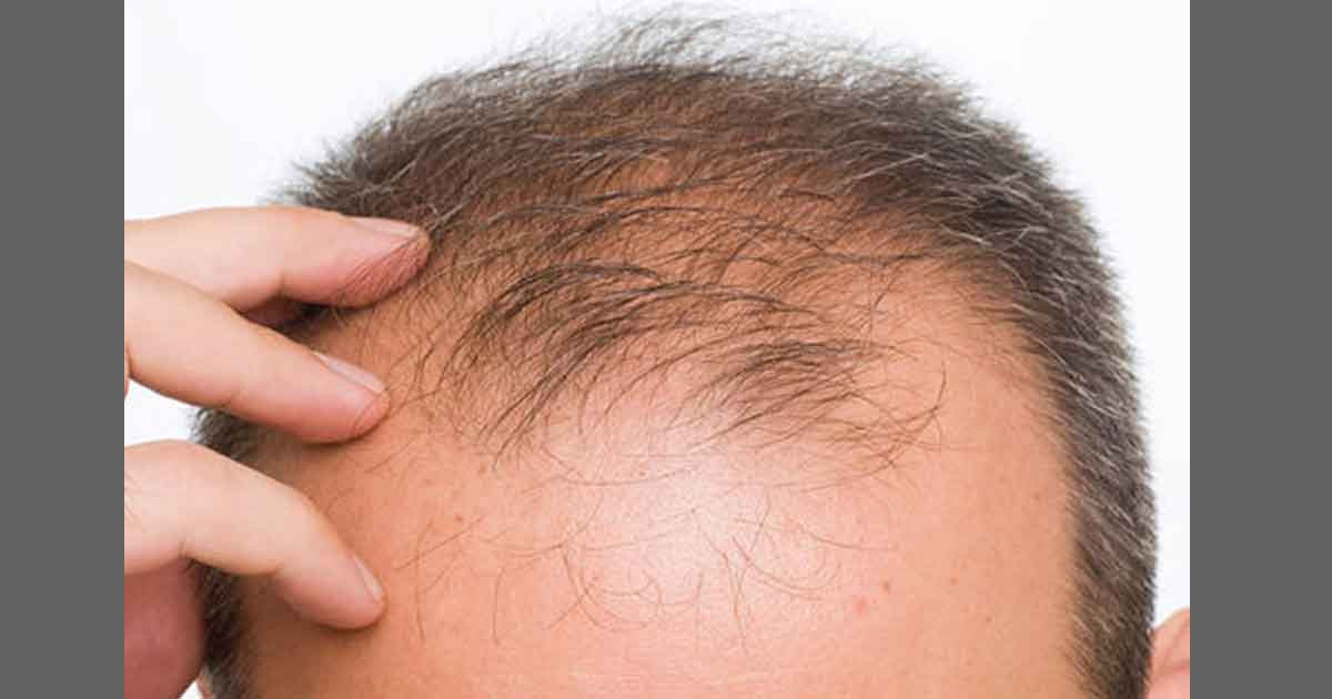 শীতে চুল পড়া কমাতে যা করণীয়