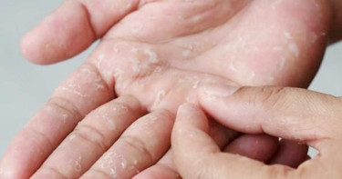 যে ভিটামিনের অভাবে শীত আসতেই ওঠে হাতের চামড়া