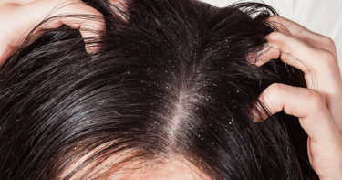 যে ভিটামিনের অভাবে শীতকালে মাথায় খুশকি হয়