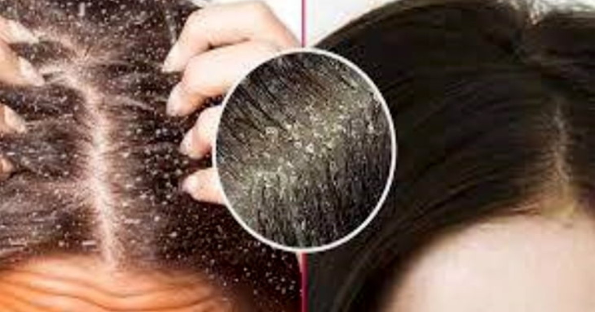 শীতকালে মাথায় অতিরিক্ত খুশকি, যে ভিটামিনের অভাব