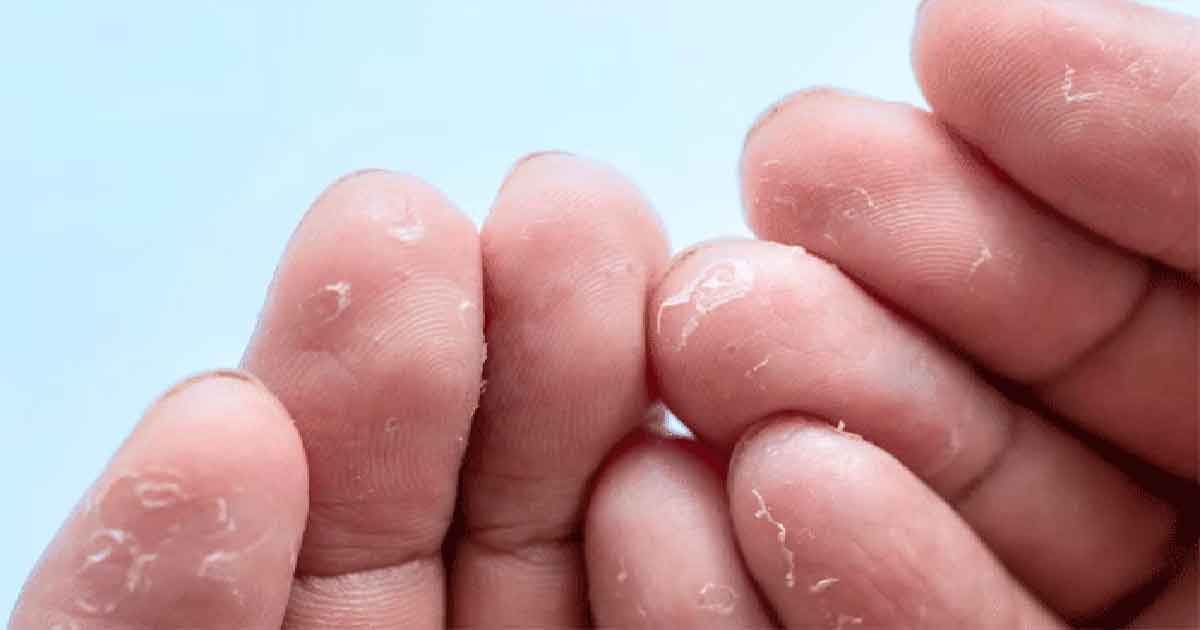 শীতকালে হাত ও পায়ের চামড়া উঠে যে ভিটামিনের অভাবে