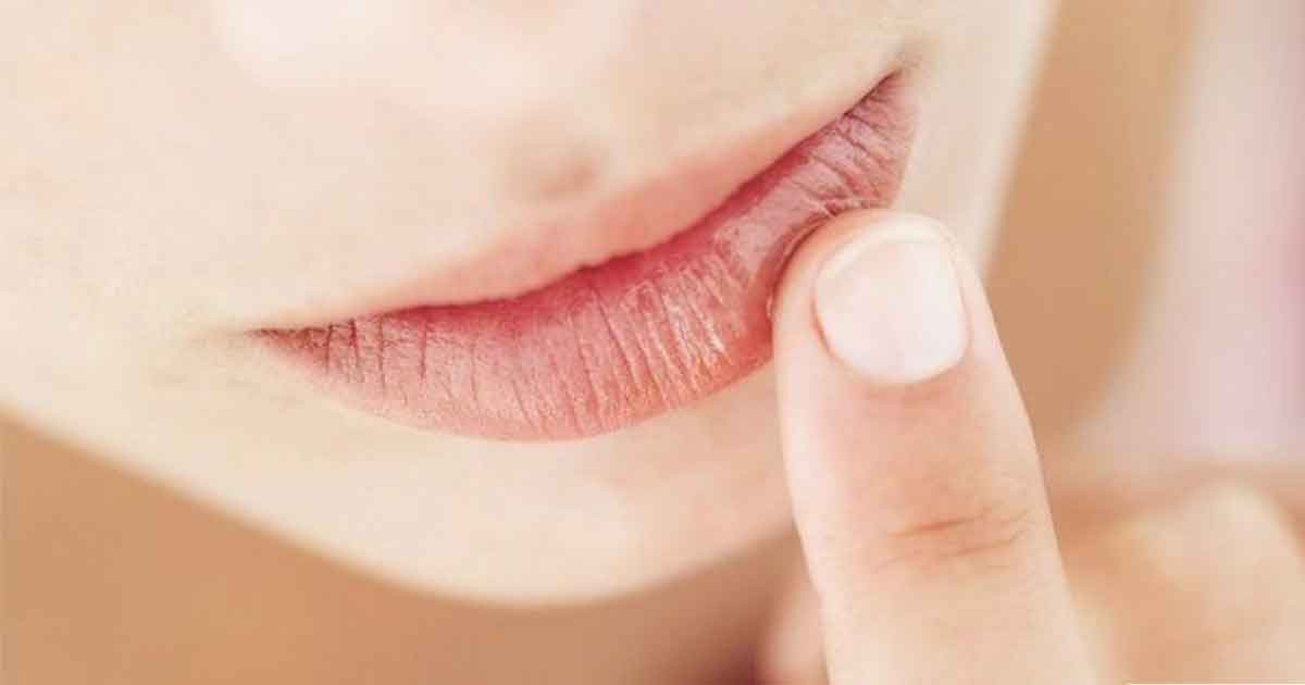 যে ভিটামিনের অভাবে ঠোঁট ফাটে