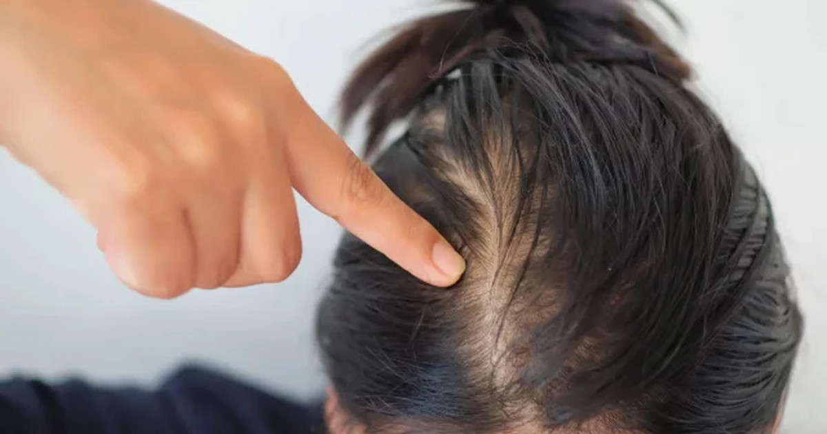 চুল পড়ে মাথা খালি হচ্ছে? ঘরোয়া ৩ উপায়ে মিলবে সমাধান