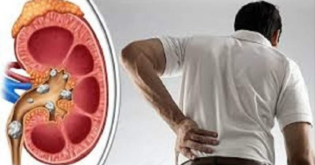 কিডনিতে পাথর হয়েছে কিনা বুঝবেন যেভাবে