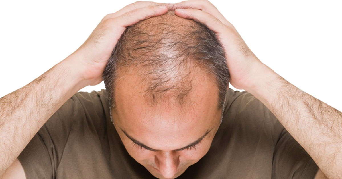 যে পাঁচ অভ্যাস পুরুষদের অতিরিক্ত চুল পড়ার জন্য দায়ী