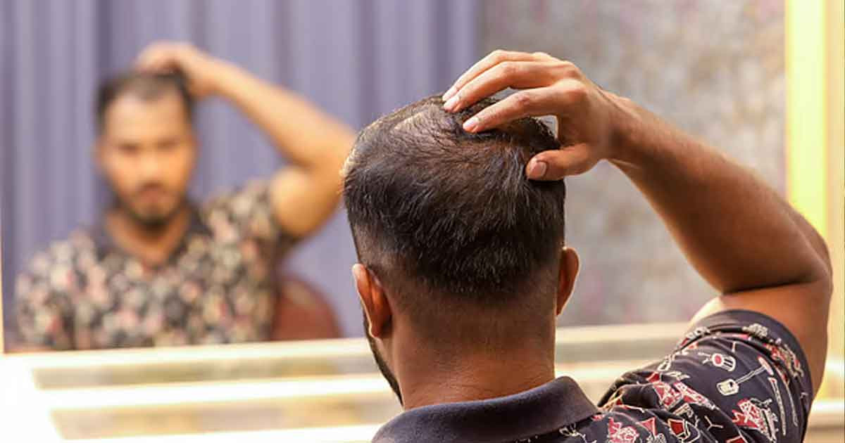 মাথায় টাক পড়ছে? প্রতিরোধে যা করবেন