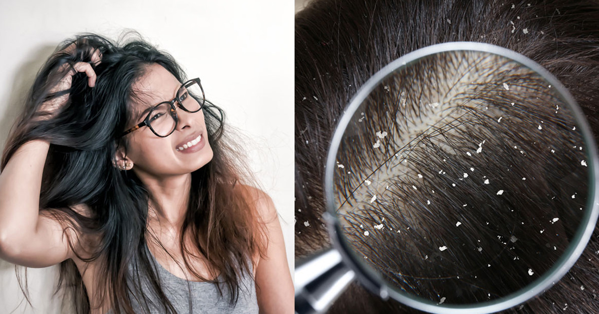 নিয়মের পরিবর্তন করলেই দূর হবে মাথার খুশকি