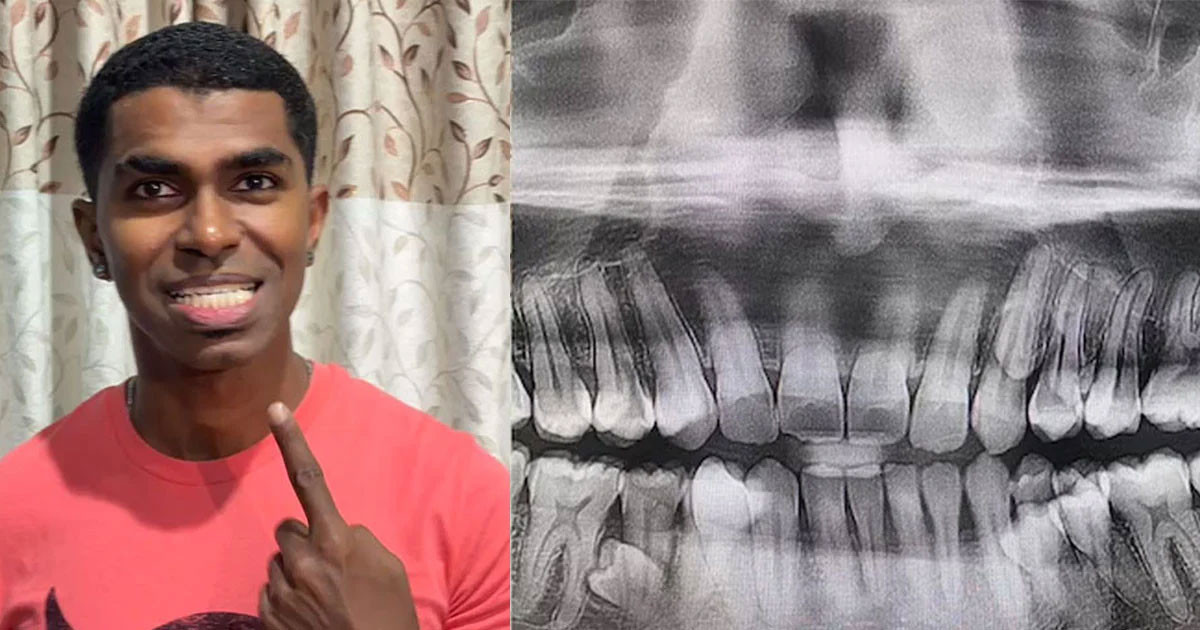 ৪২টি দাঁত নিয়ে গিনেস রেকর্ড গড়লেন মালয়েশিয়ার যুবক