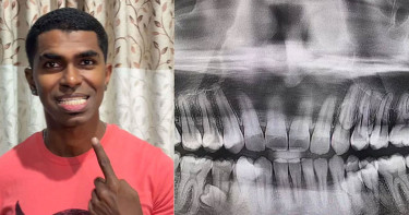 ৪২টি দাঁত নিয়ে গিনেস রেকর্ড গড়লেন মালয়েশিয়ার যুবক