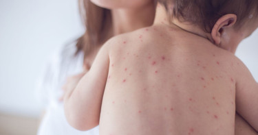 হাম কী, কীভাবে ছড়ায়? টিকাবঞ্চিত শিশুরাই কেন বেশি ঝুঁকিতে!