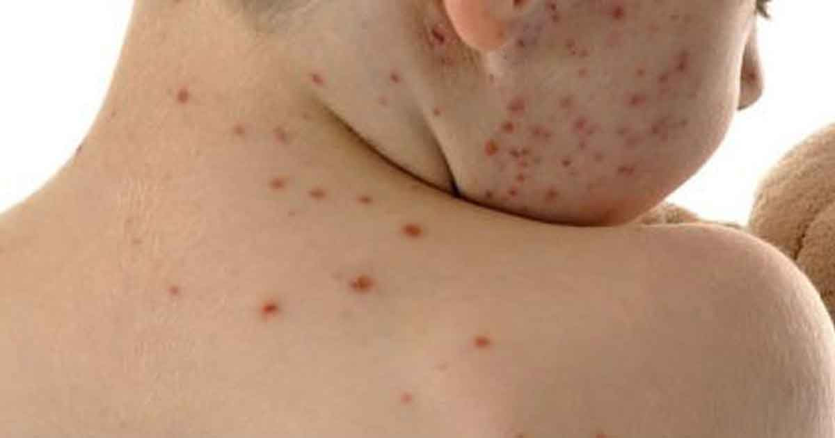 ছয় কারণে বাড়ছে হামের সংক্রমণ