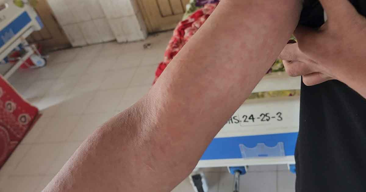 শরীয়তপুরে ছড়িয়ে পড়ছে হাম, মারা যাচ্ছে শিশু