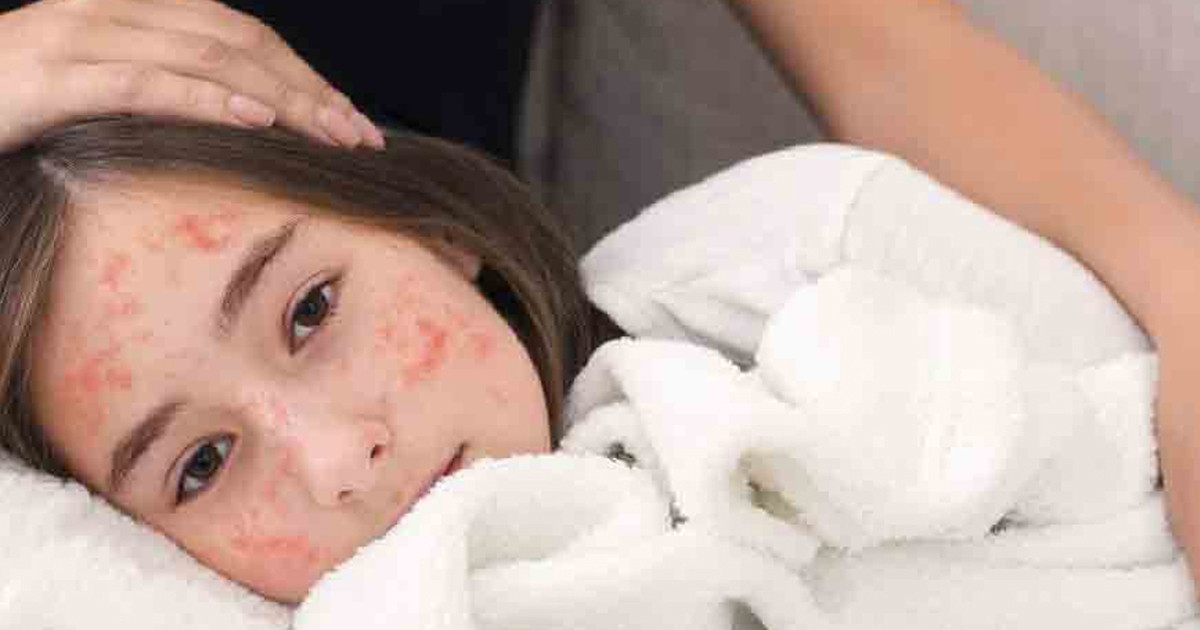 হাম কী, কেন ও কীভাবে ছড়ায়?