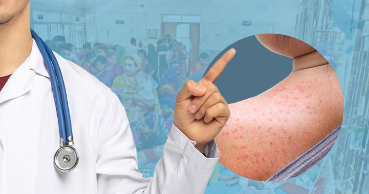 রোববার থেকে দেওয়া হবে হামের টিকা