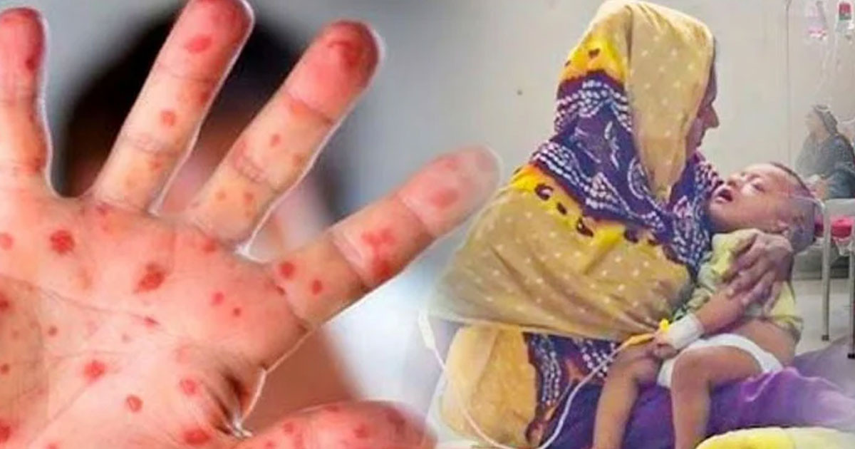 ১৯ দিনে হাম উপসর্গে ৯৪ জনের মৃত্যু, সংক্রমণ ছড়িয়েছে ৫৬ জেলায়