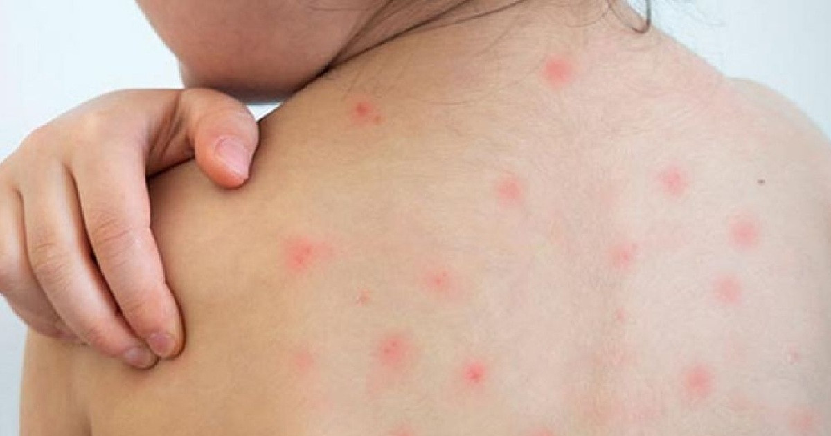 বাবা-মায়ের ৭ ভুলে হাম নিয়ে হতে পারে মারাত্মক বিপদ