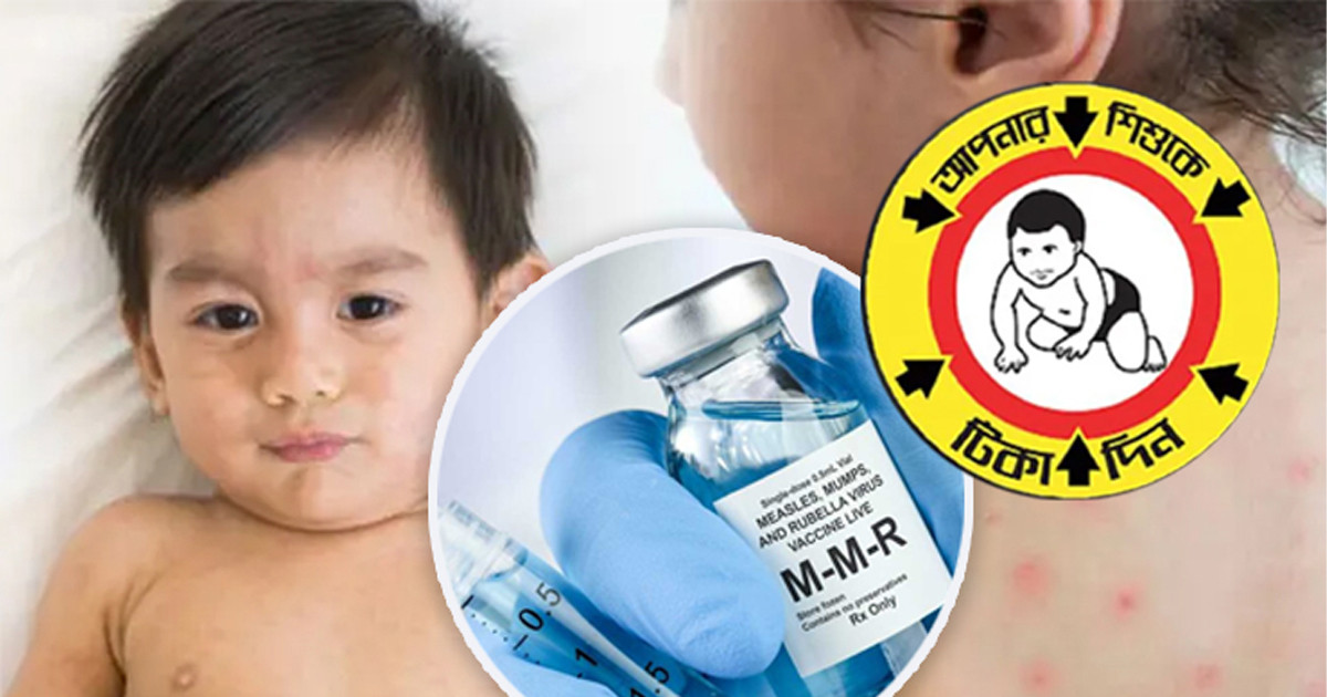 যেসব শিশুকে দেয়া যাবে না হামের টিকা