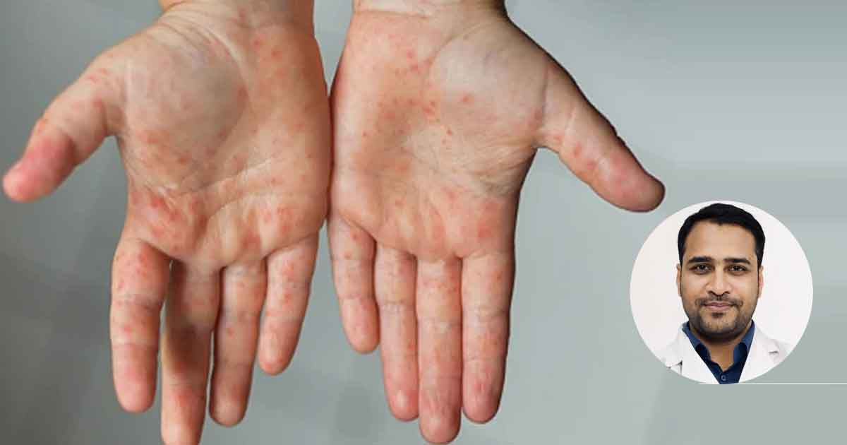 বাংলাদেশে হাম রোগের পুনরুত্থান, লক্ষণ, চিকিৎসা ও প্রতিরোধ