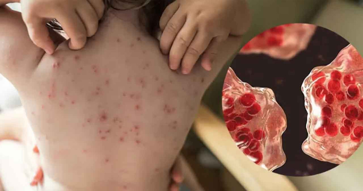 হামের উপসর্গে ২৪ ঘণ্টায় চার শিশুর মৃত্যু, নতুন ভর্তি ২৭