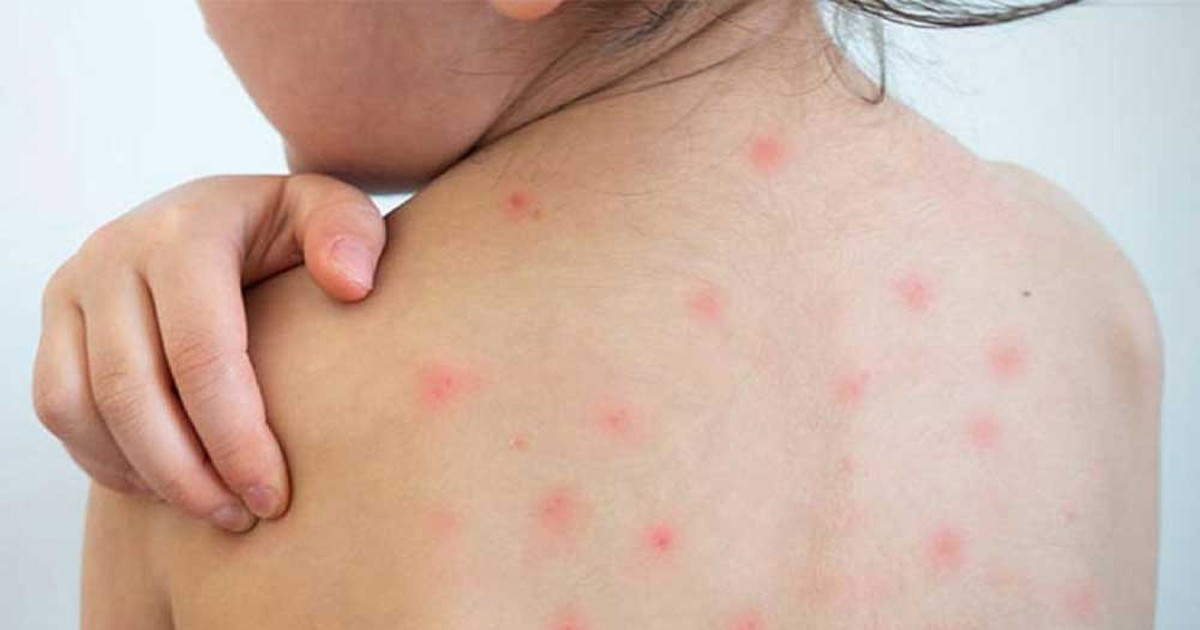 হামের উপসর্গ নিয়ে আরও ৭ শিশুর মৃত্যু