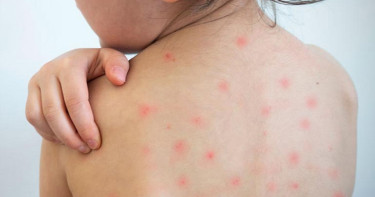 হামের লক্ষণ নিয়ে ২৪ ঘণ্টায় চারজনের মৃত্যু