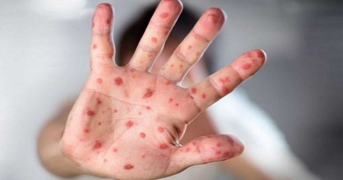 হাম: ২৪ ঘণ্টায় প্রাণ গেল আরও ১০ শিশুর