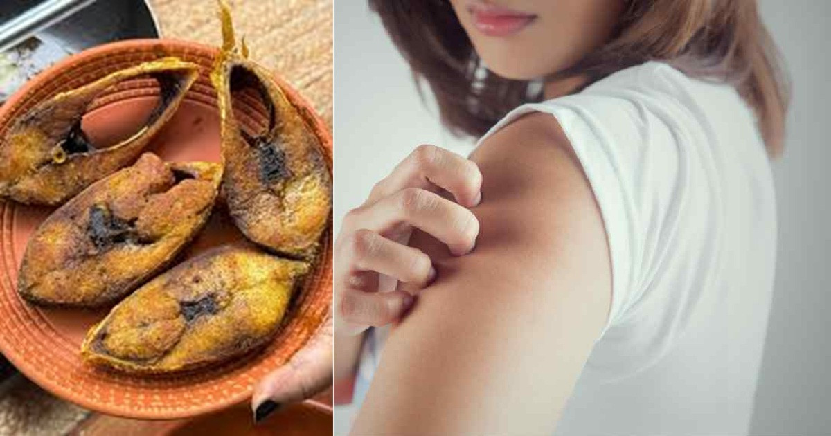 ইলিশ খেয়ে অ্যালার্জি বাড়লে যা করবেন