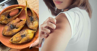 ইলিশ খেয়ে অ্যালার্জি বাড়লে যা করবেন