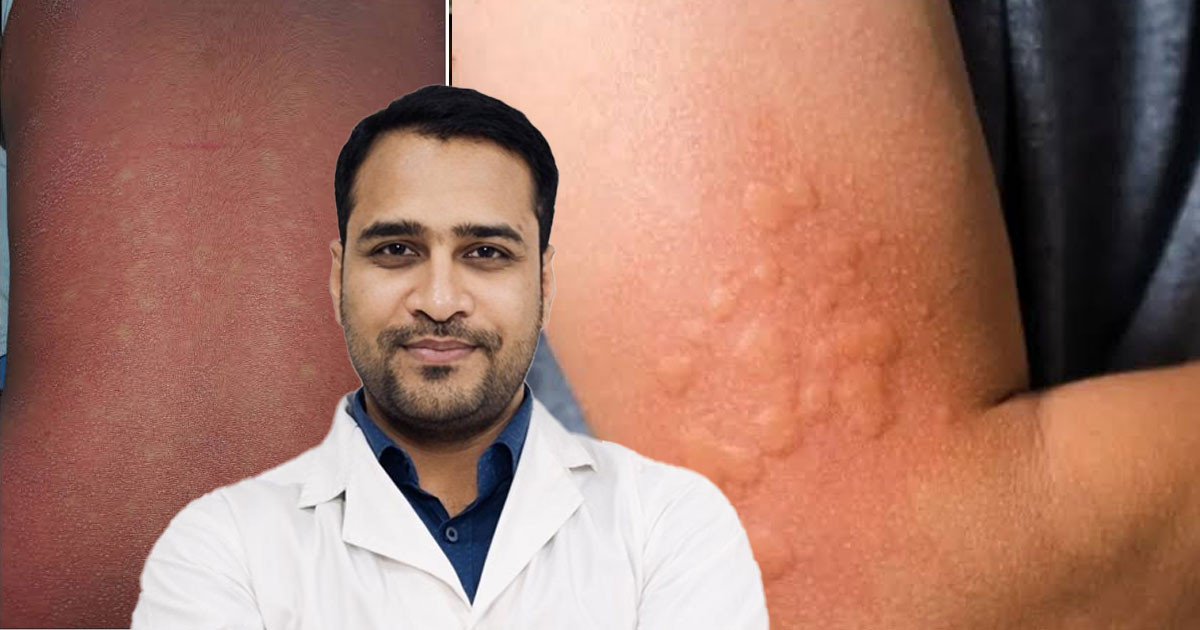 সব র‍্যাশ মানেই হাম নয়!