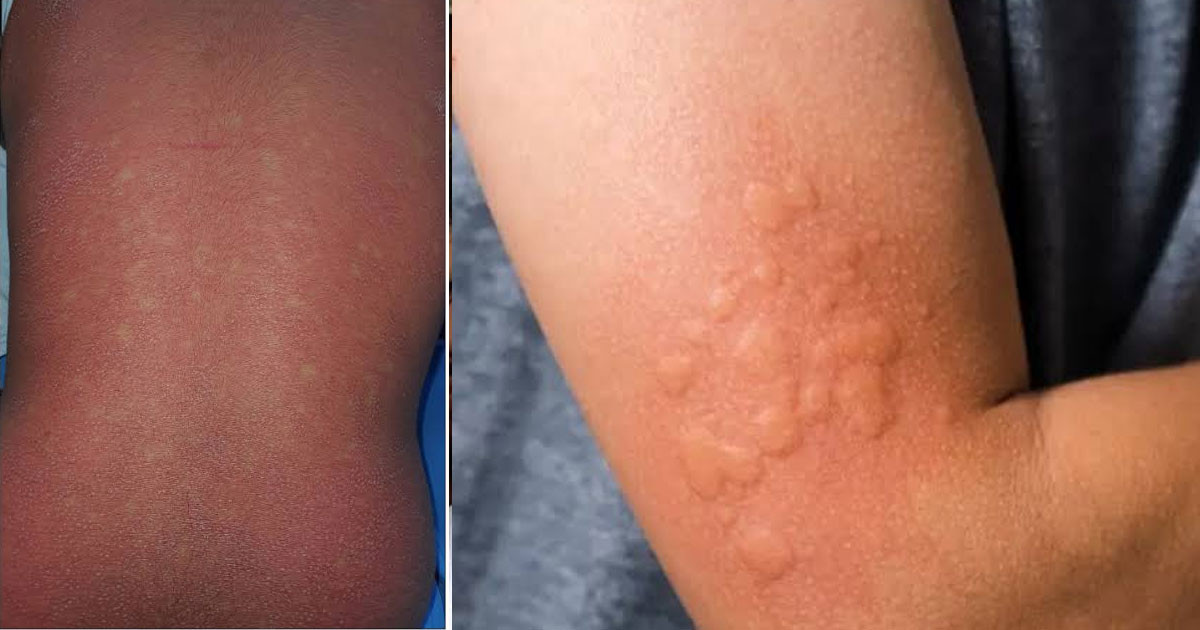 সব র‍্যাশ মানেই হাম নয়!