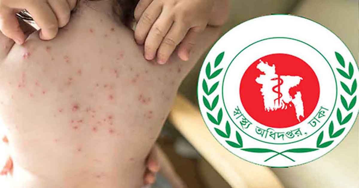 হামে আক্রান্ত হলে করনীয় কী?