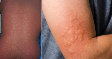 সব র‍্যাশ মানেই হাম নয়!