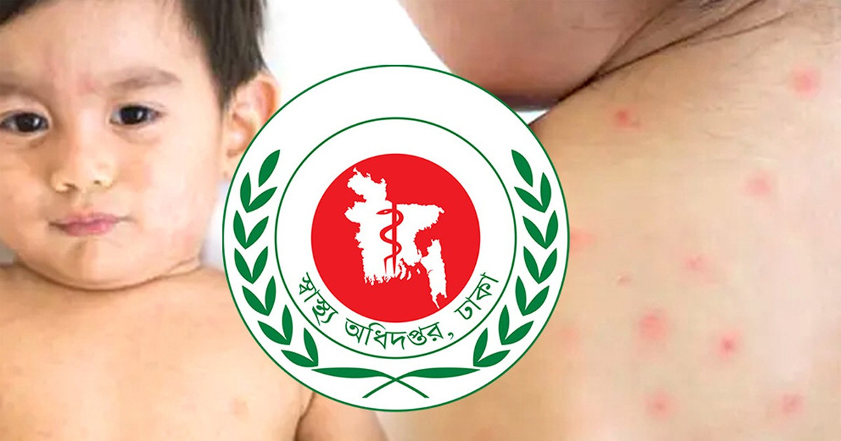 হামের উপসর্গ নিয়ে আরও ৪ জনের মৃত্যু