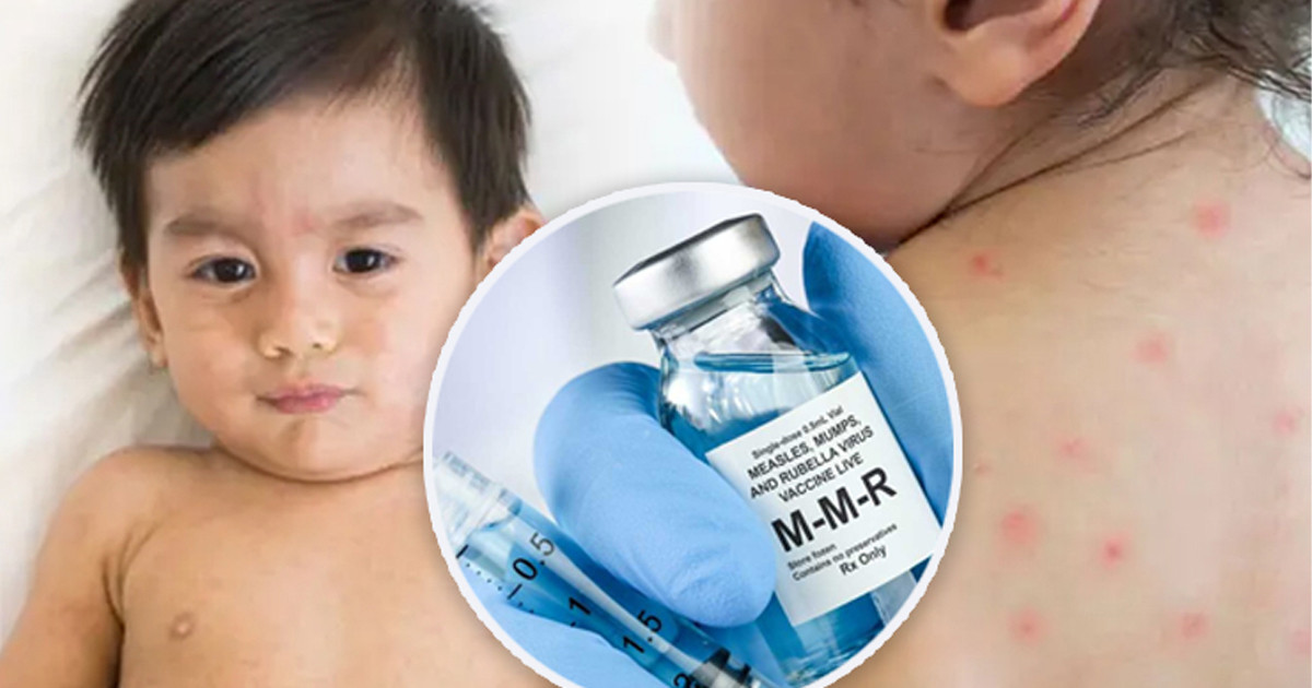 আগামীকাল থেকে সারাদেশে হামের টিকাদান কর্মসূচি শুরু