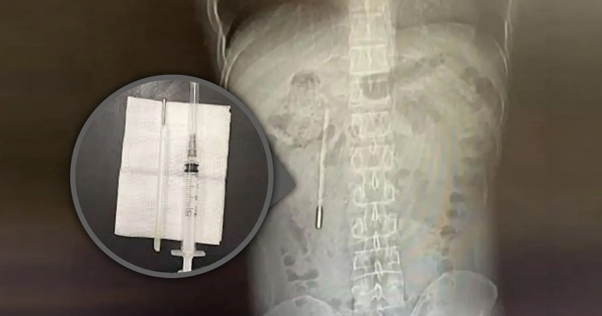 পেটে ব্যথা নিয়ে হাসপাতালে যুবক, সামনে এলো অবিশ্বাস্য ঘটনা