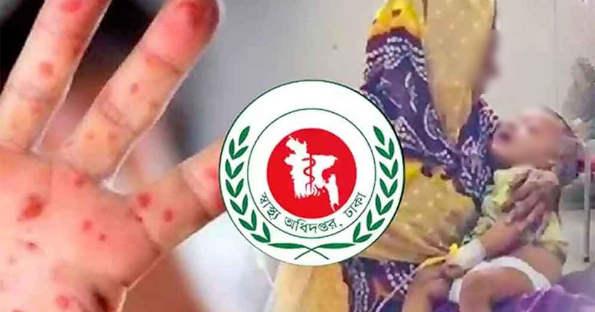সিলেটে হাম ও উপসর্গে ৫ শিশুর মৃত্যু