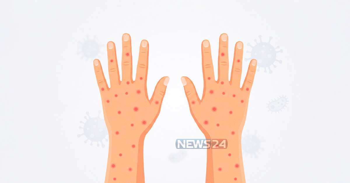 হাম উপসর্গে আরও ৪ শিশুর মৃত্যু